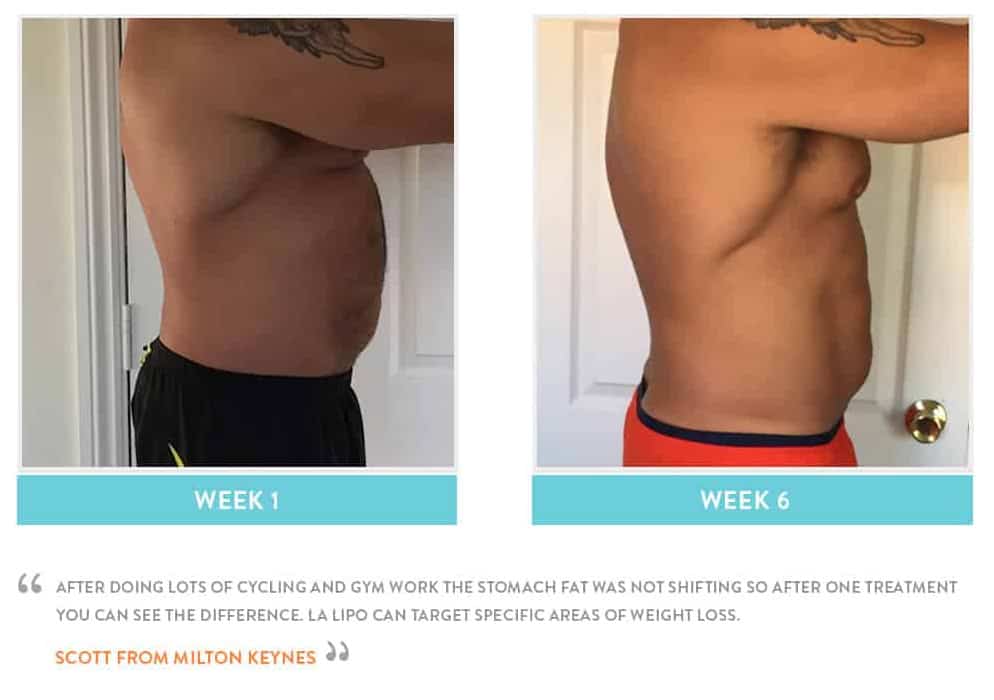 Before & After Stomach Fat Hertford