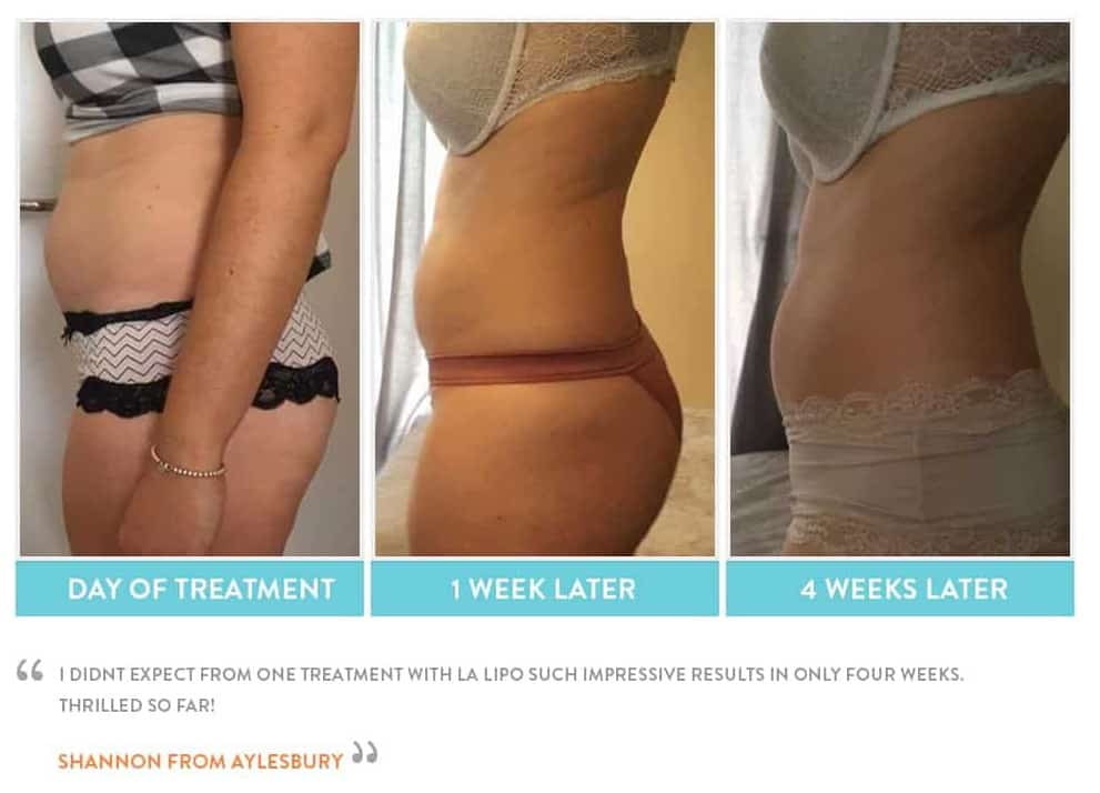 before, Cryolipolysis Hertford