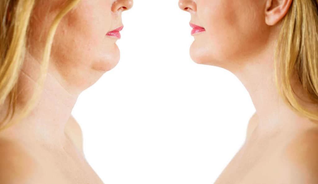 Double Chin treatment Hertford before and after results