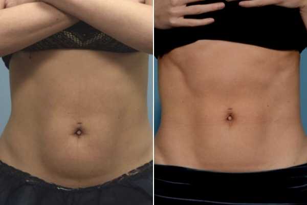 body sculpting FAQs Hertford