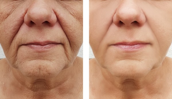 Learn more about Morpheus8 Treatment Hertford today!