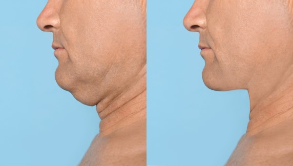 Which Non-Surgical Treatments Work Best for Jowls and Loose Skin Hertford?