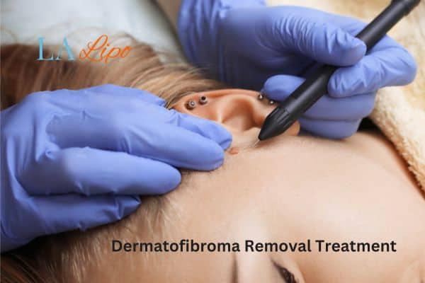 Dermatofibroma Removal Treatment Hertford