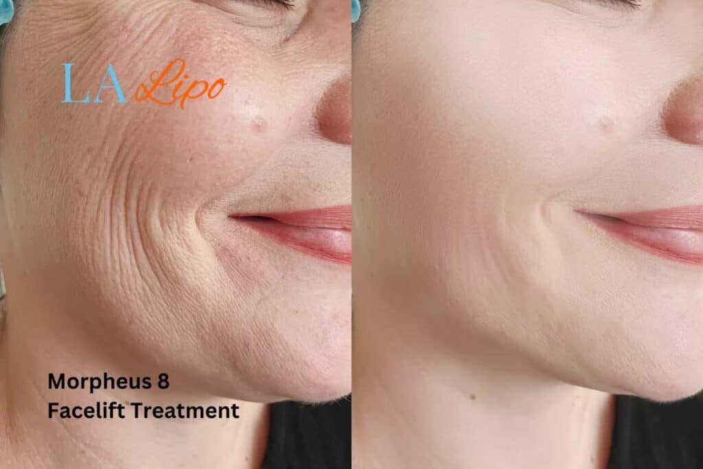 Morpheus8 Treatment Hertford for flawless skin! Call us today!