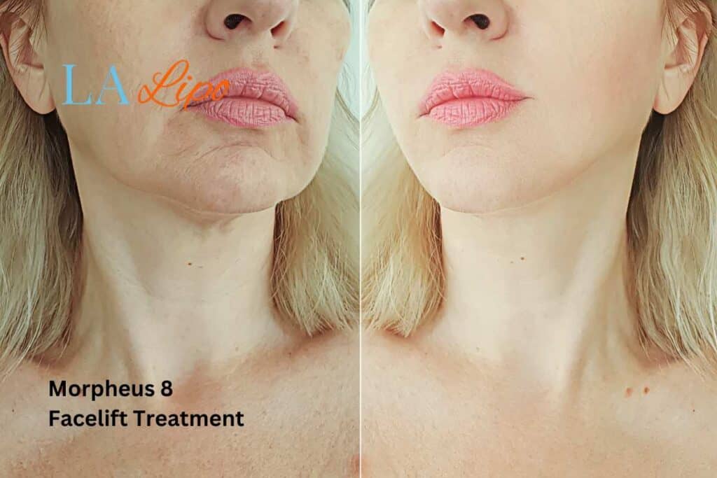 Turn back time with Morpheus8 Treatment Hertford