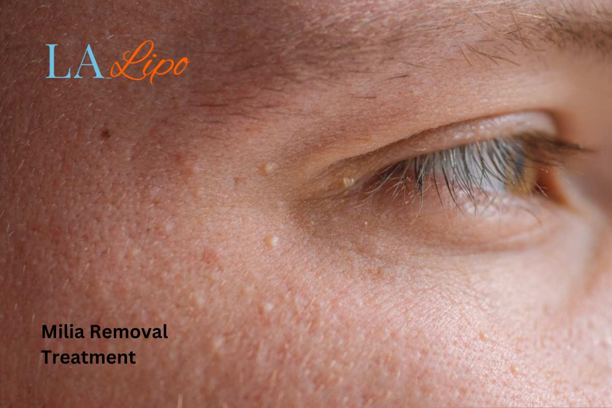 Cryopen Milia Removal: Is It the Easiest and Safest Option Hertford?