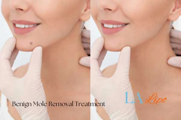 woman's before and after mole removal Hertford results