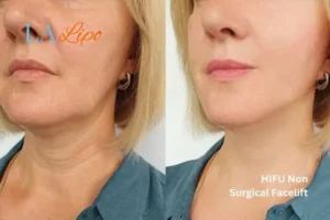 hi-fu for wrinkles Hertford before and after results