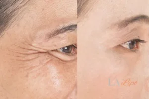 Before and after results of woman - HI-fu wrinkles reduction treatment Hertford