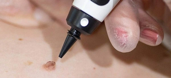 skin tag removal using cryopen Hertford