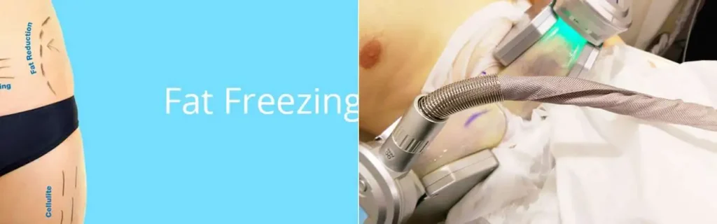 Fat freezing Hertford on multiple areas of the body