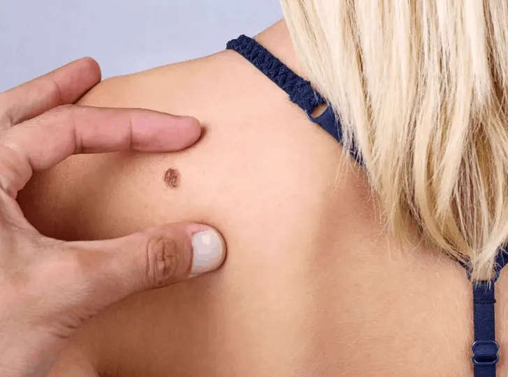 woman having mole removal Hertford consultation before treatment.