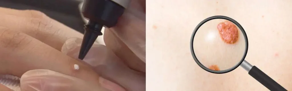 Cryopen for mole removal Hertford - speak to our team today!