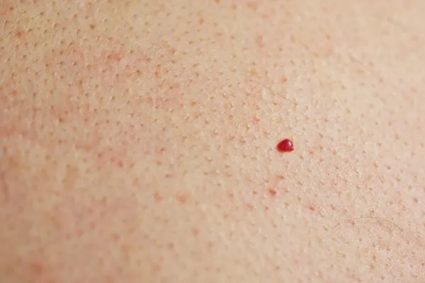 close up of a cherry angioma Hertford