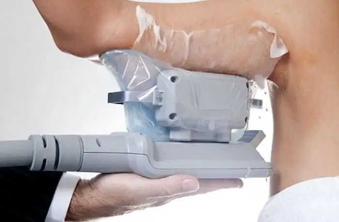 Picture of fat freezing Hertford on the upper arms.