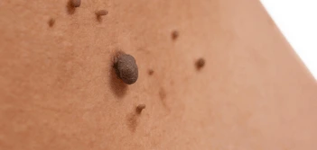 image of a skin tag Hertford