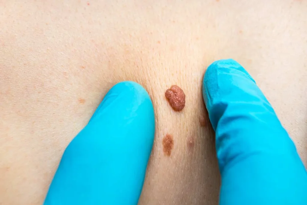Consultant examining a skin tag Hertford