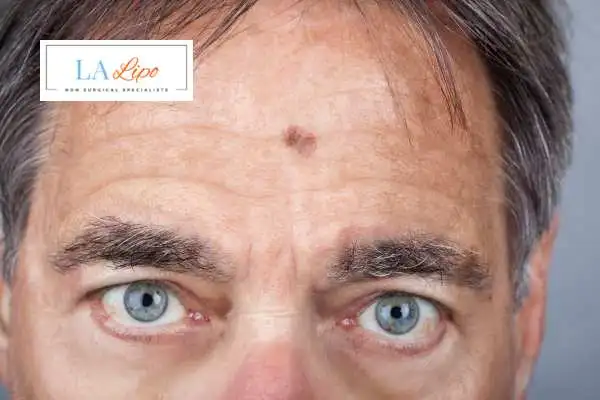 Solar Lentigo Removal Hertford image of man with mark on his forehead
