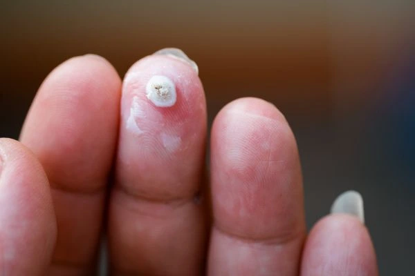 wart on person finger - cryotherapy to treat from LA LIPO Hertford
