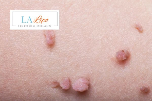 Does cryopen skin tag removal Hertford hurt? Find out now call our team today!