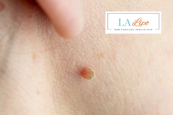 Book skin tag removal Hertford today speak to our team now!