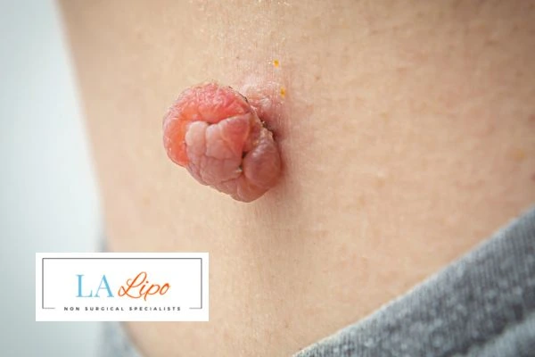 Interested in skin tag removal Hertford? Concerned about the pain? Find out more today!