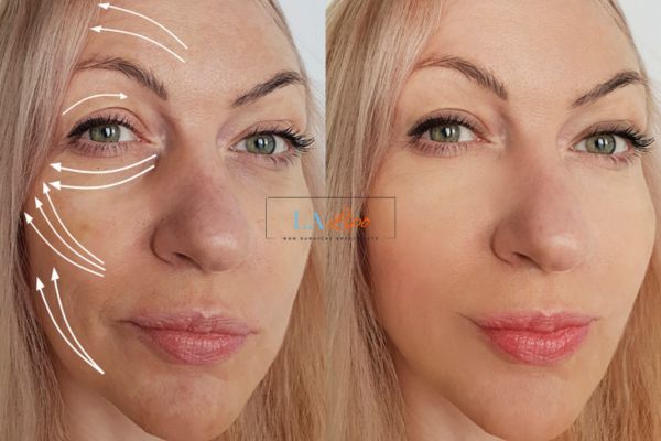 Morpheus 8 results Hertford face lift.