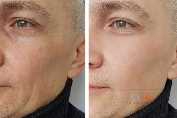 See the amazing results of Morpheus8 Treatment Hertford!