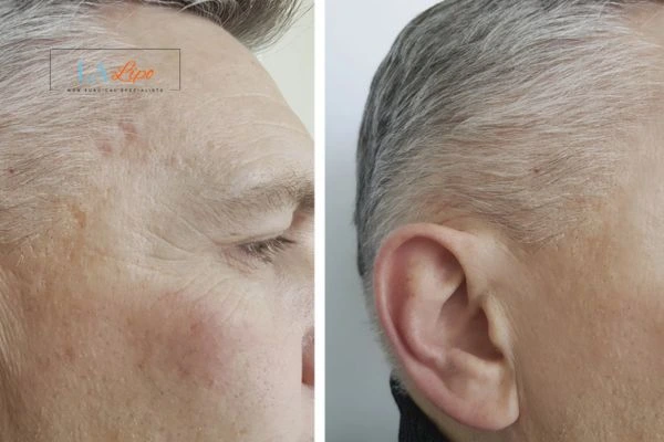 Mens Before & After Morpheus 8 Results Hertford