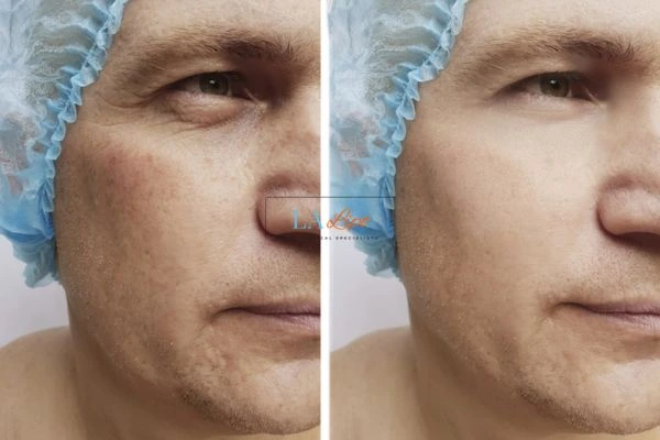 Before and after Morpheus 8 Results Hertford