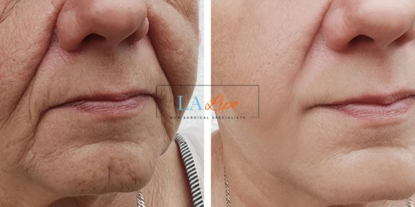 Older lady deeper wrinkle reduction - LA LIPO Morpheus 8 Results Hertford