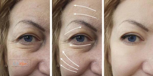 Amazing eye lift Morpheus 8 results Hertford