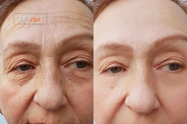 The powerful benefits of Morpheus8 Treatment Hertford - Call Our team today!