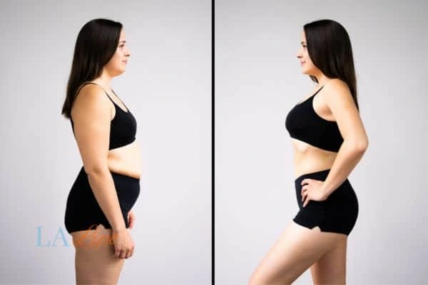 Picture of womans before and after using LA-EMS body sculpting to improve her core strength Hertford