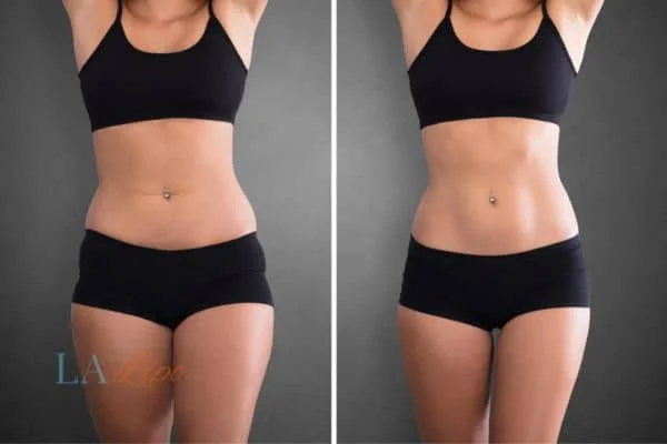 before and after results of non-surgical treatment to help a woman's body image and mental health Hertford