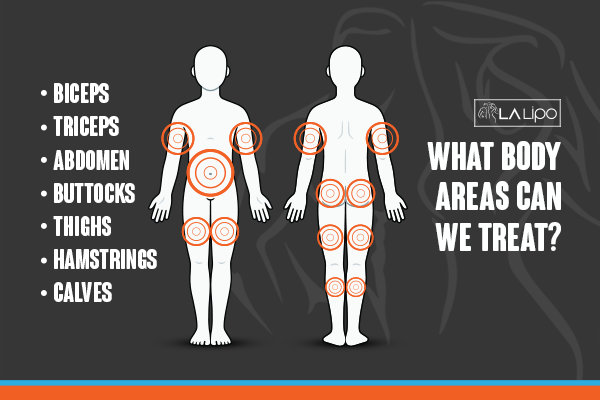 Diagram to show areas you can have LA-EMS Body Sculpting Treatment Hertford