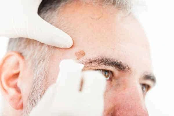 Age spots and elderly people Hertford what is the link?