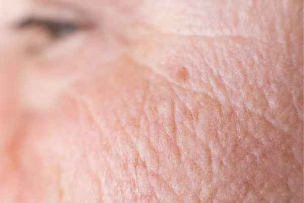 close up picture of a woman's face showing an age spot Hertford