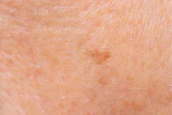 close up picture of age spots Hertford
