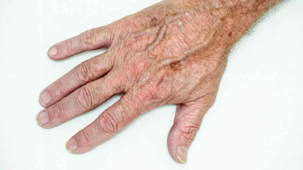 Male hand showing age spot Hertford