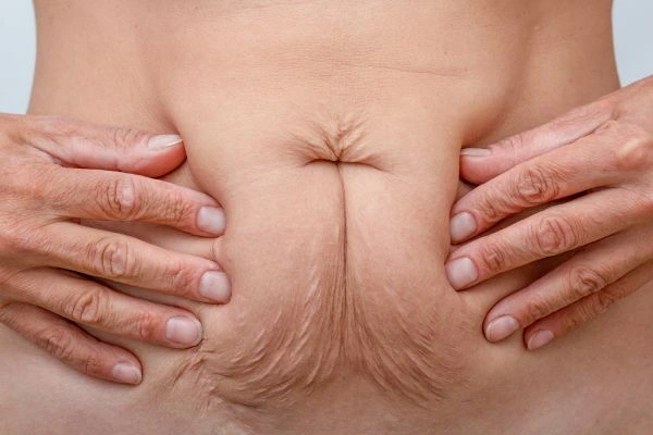 Should I Combine Diastasis Recti Treatment with Body Contouring for Better Results Hertford?