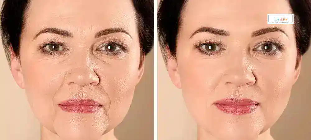 How Long Does It Take to See Results and How Long Do They Last Hertford?
