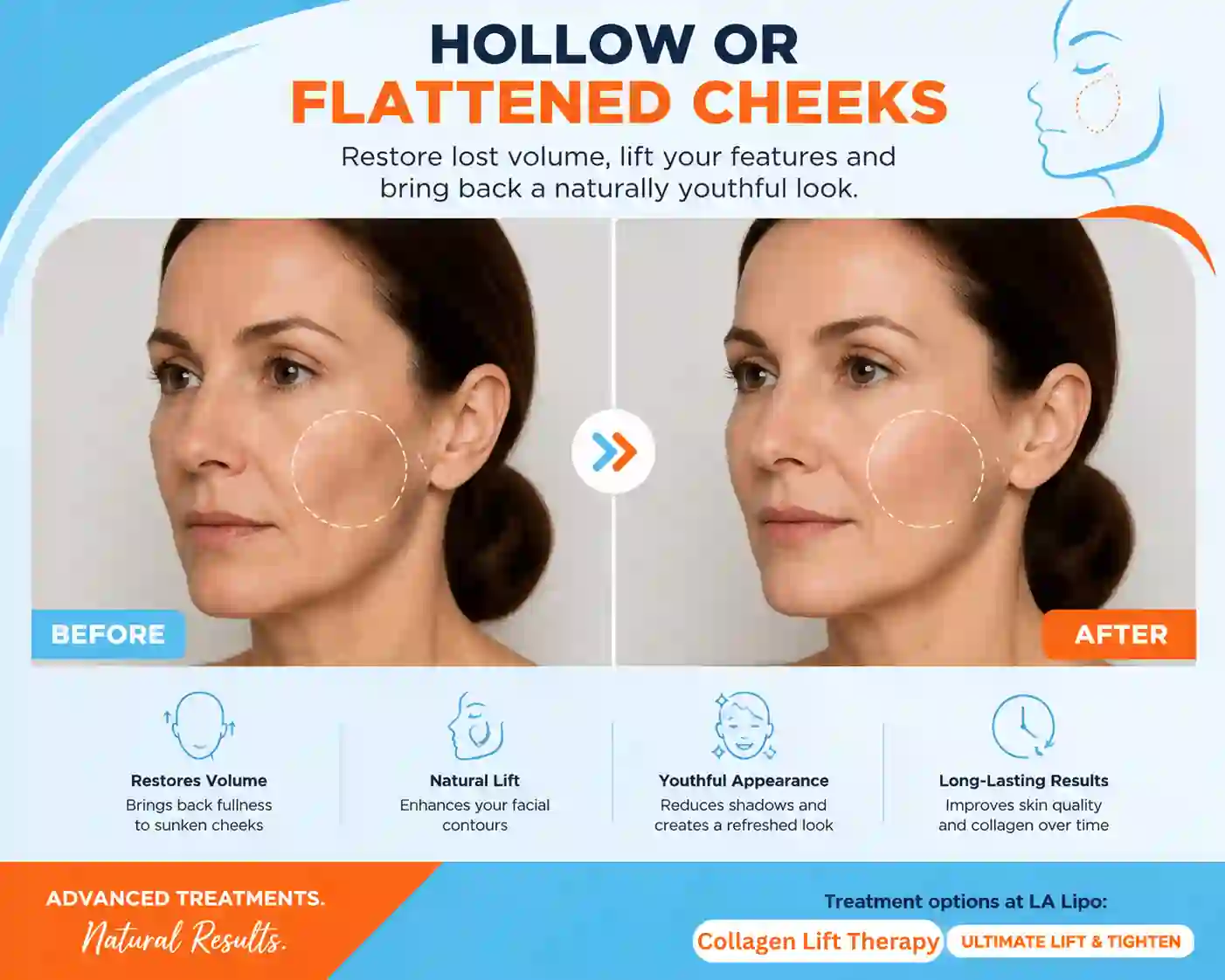 Sign #4: Hollow or Flattened Cheeks Hertford