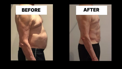 What Symptoms Can Diastasis Recti Cause in Men? Weak Core, Back Pain and Poor Posture Hertford